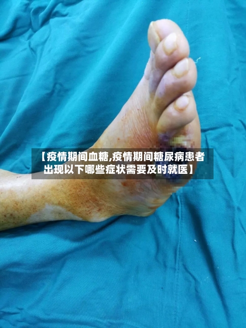 【疫情期间血糖,疫情期间糖尿病患者出现以下哪些症状需要及时就医】-第2张图片