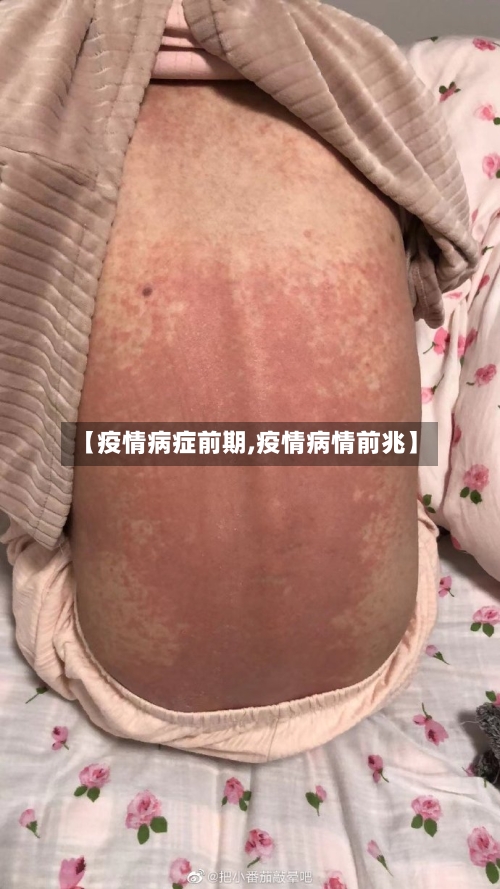【疫情病症前期,疫情病情前兆】-第2张图片